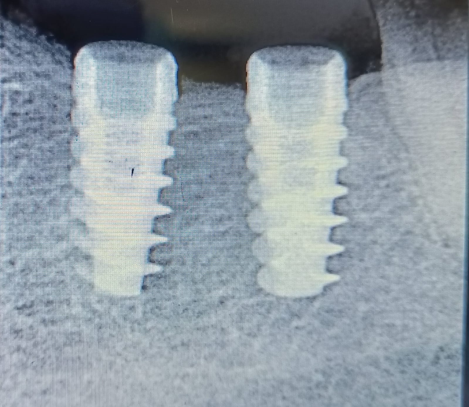 Dental implant after treatment