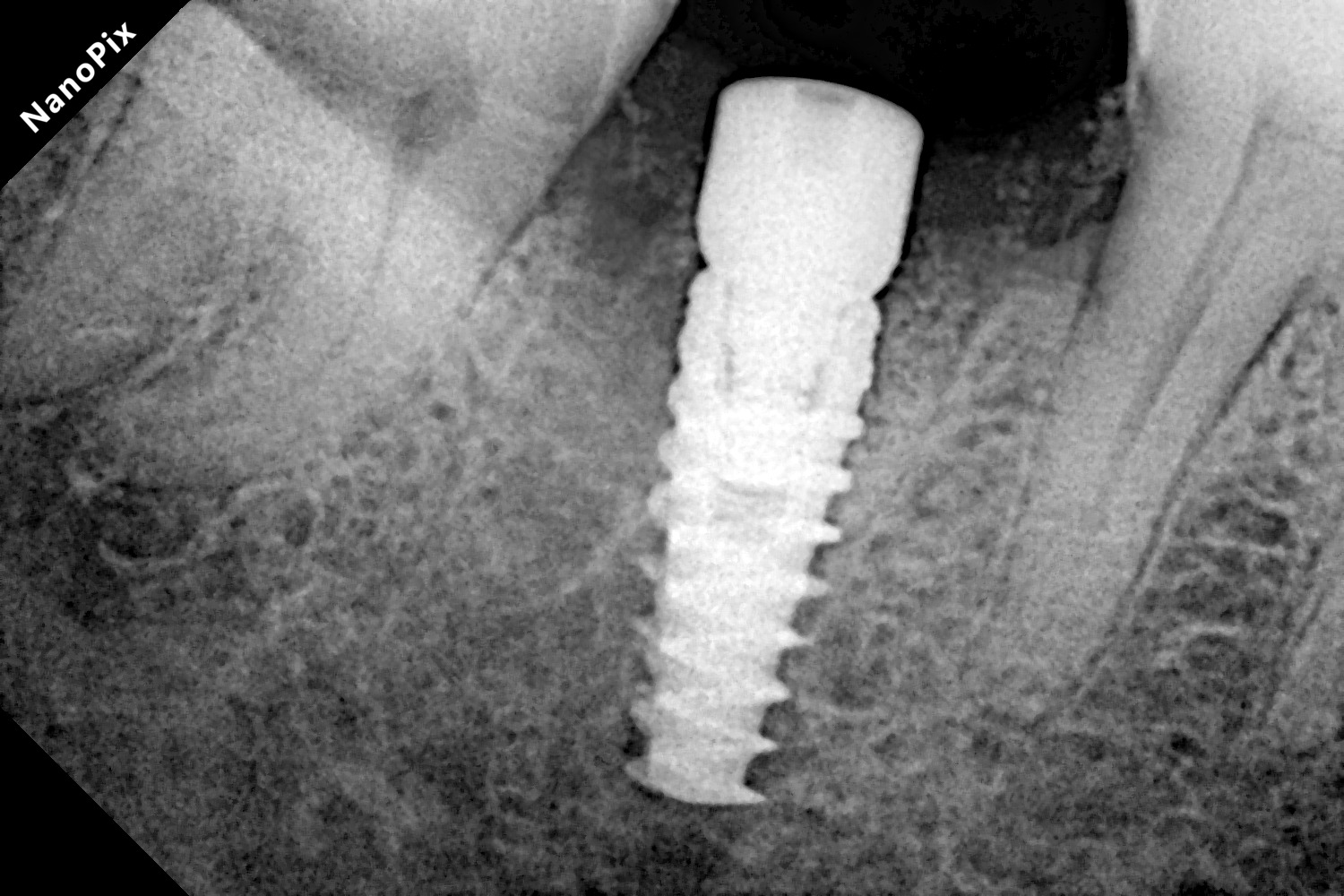 Dental implant after treatment