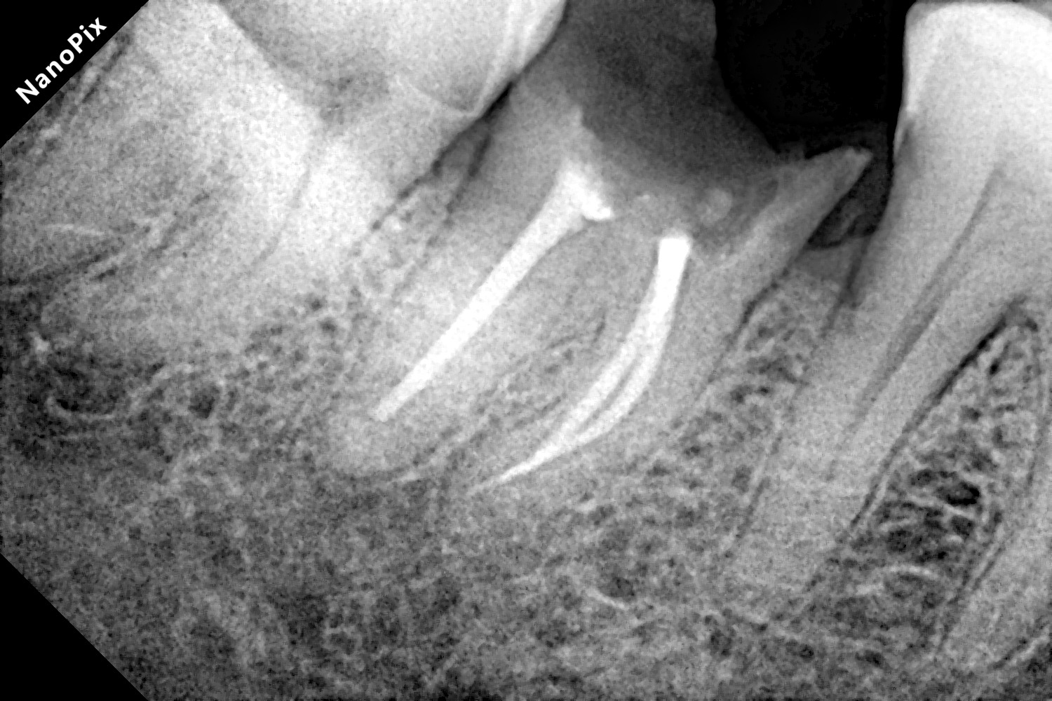 Dental implant before treatment