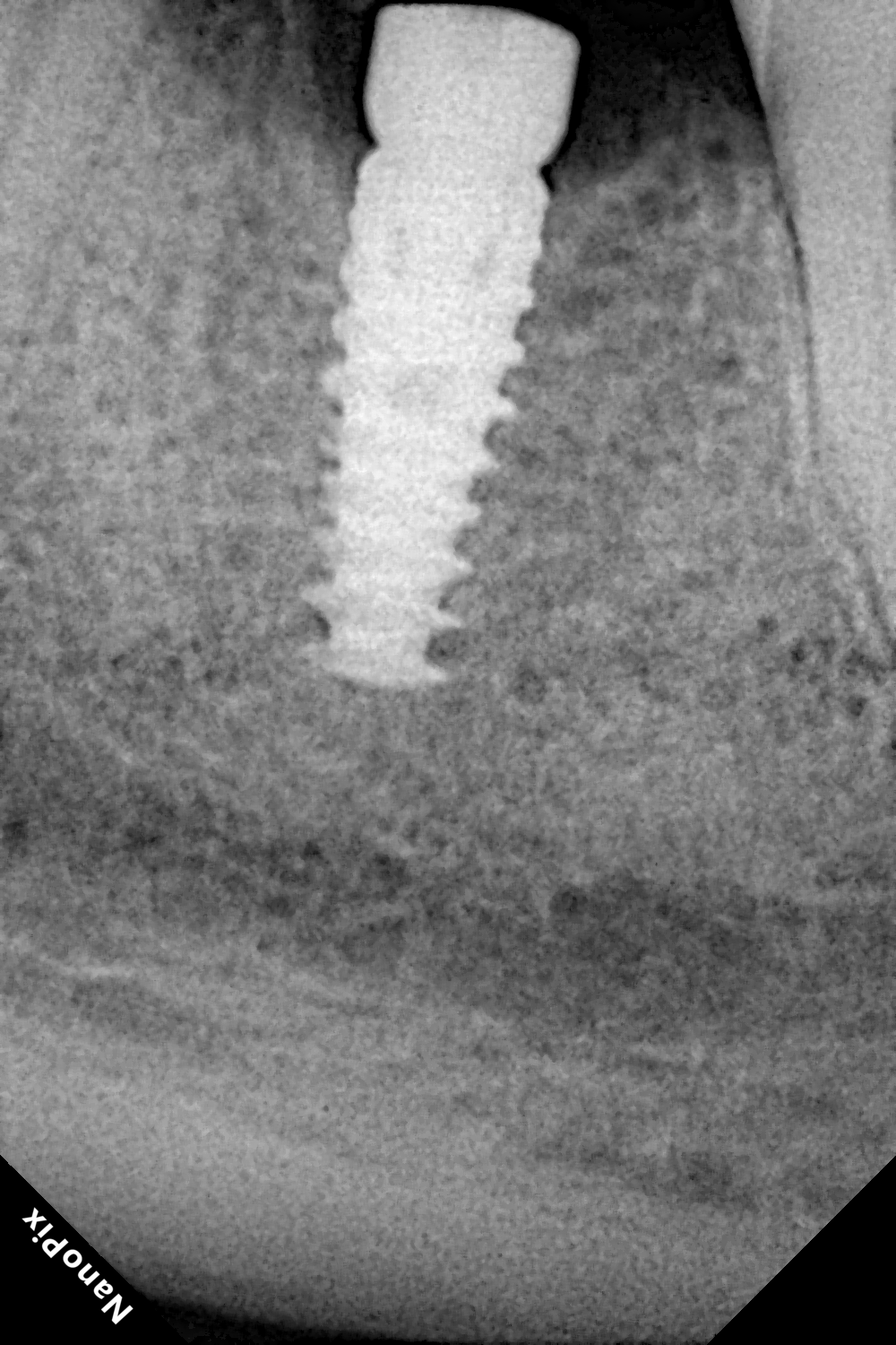 Dental implant after treatment