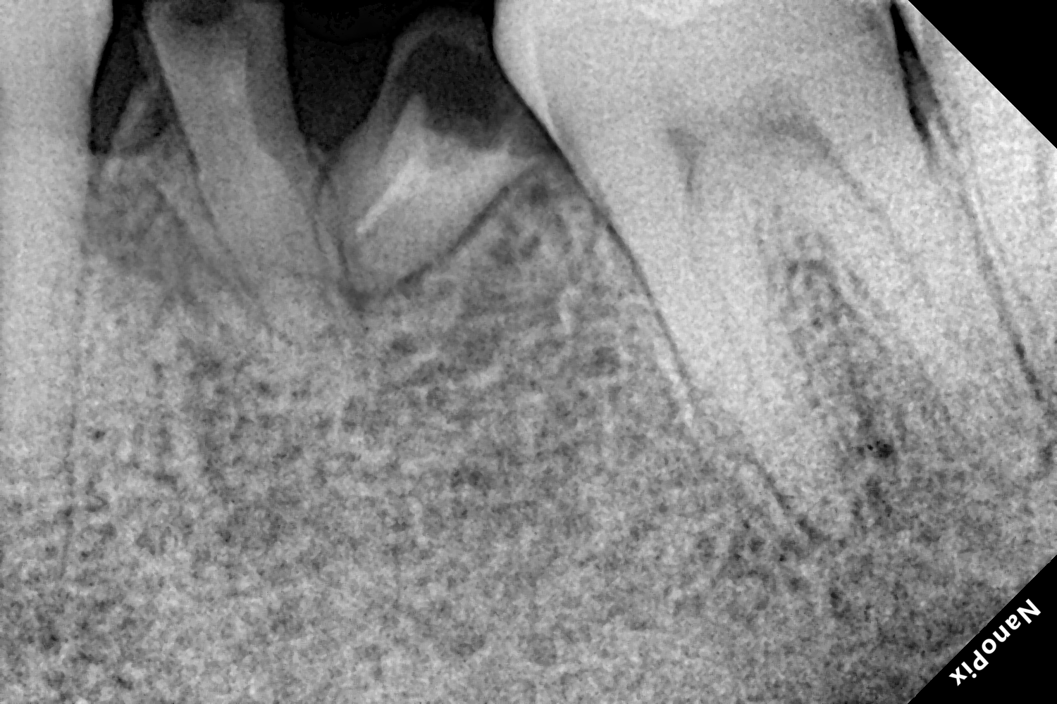 Dental implant before treatment